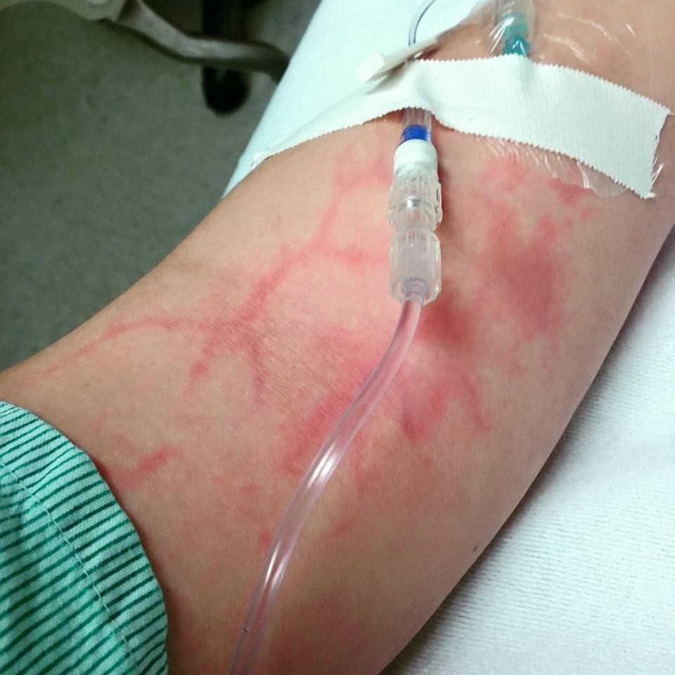 A tiny rash on Haley's leg spread quickly over a four-hour period, indicating the bug was spreading through her body