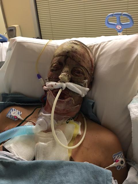  Courtney had to undergo several skin grafts and spent 51 days in hospital