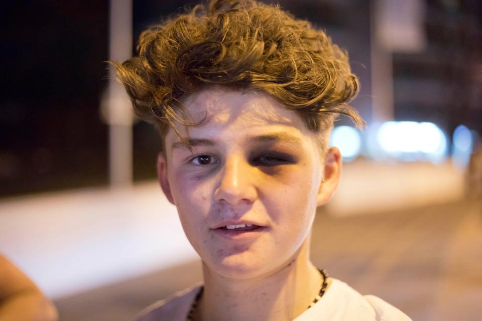  Teenager Jordan Thomas got a black eye during an altercation with Spanish authorities