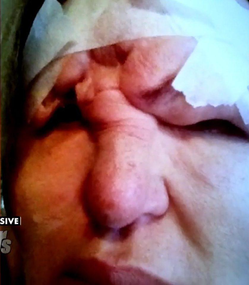  Carol Bryan, from the US, was left blind in one eye after her dermal filler injection went wrong