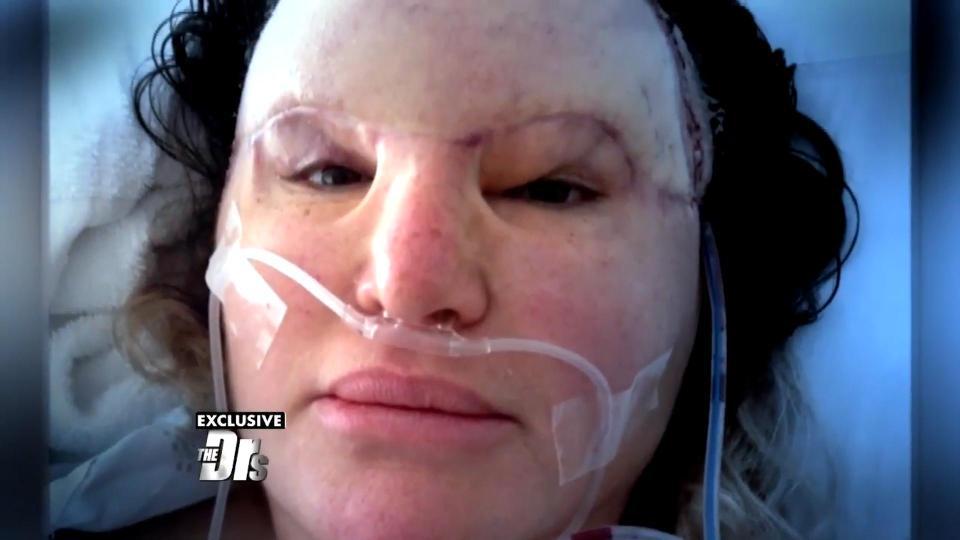  Carol Bryan was forced to have corrective surgery to fix the damage caused by dermal fillers