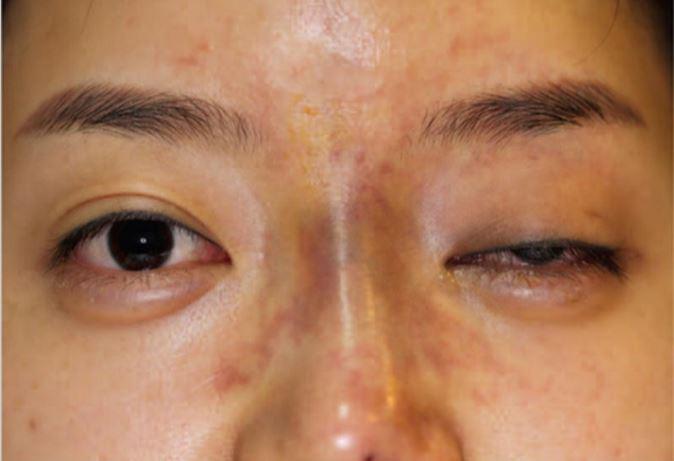  A 2017 study examined the case of a South Korean woman who went completely blind in one eye after having dermal filler injected