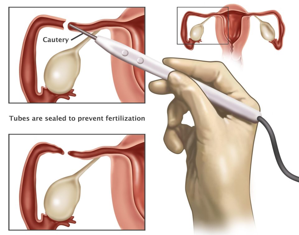  The Fallopian tubes can be blocked using a number of methods, including cutting the tube