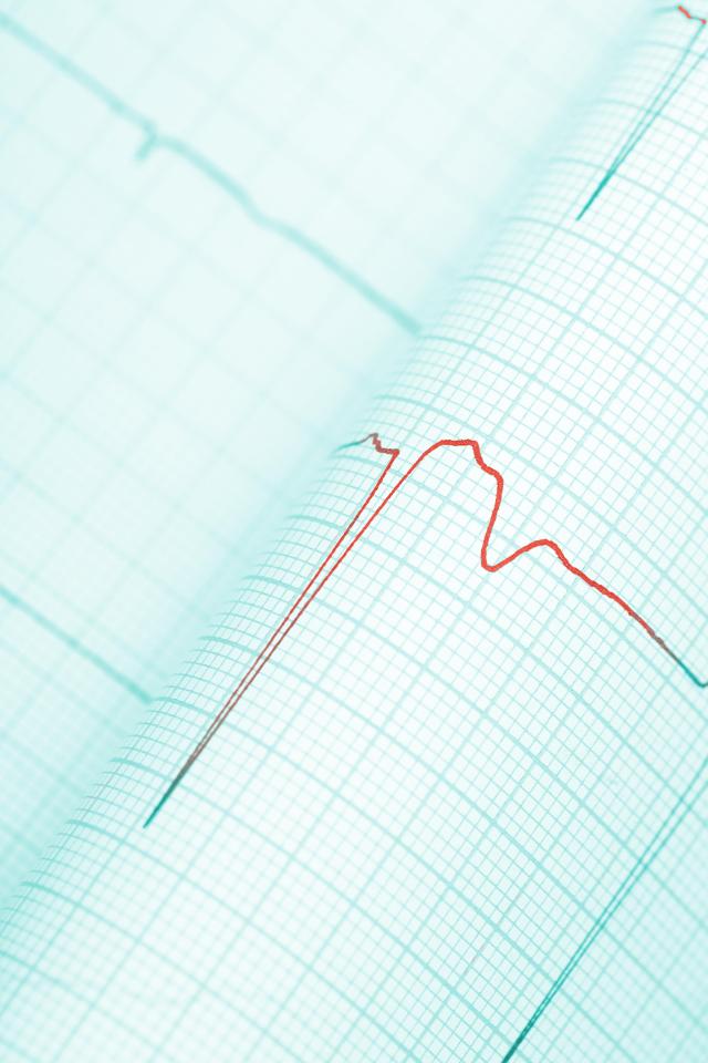  People who work 55 hours or more have an increased risk of developing an irregular heartbeat known as atrial fibrillation