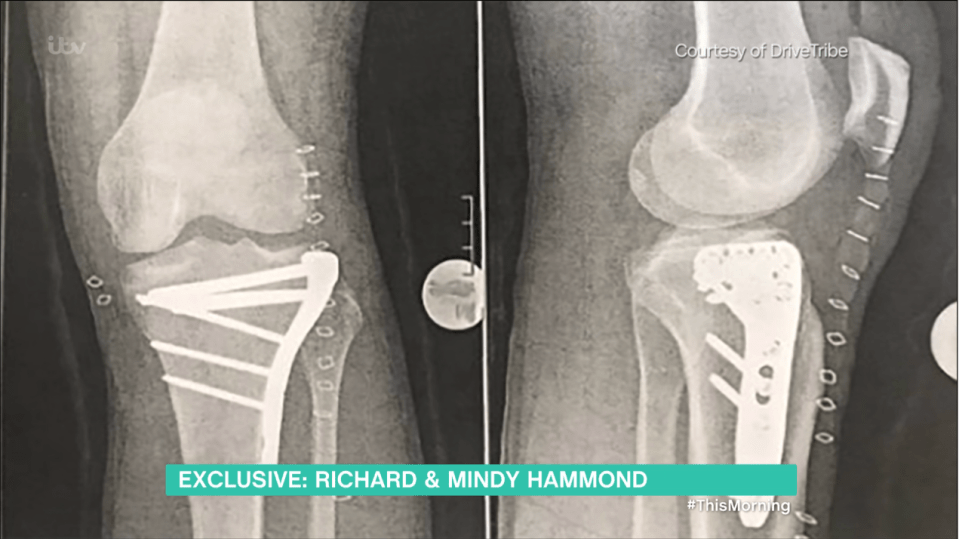  Richard revealed his knees needed extensive surgery to fix them