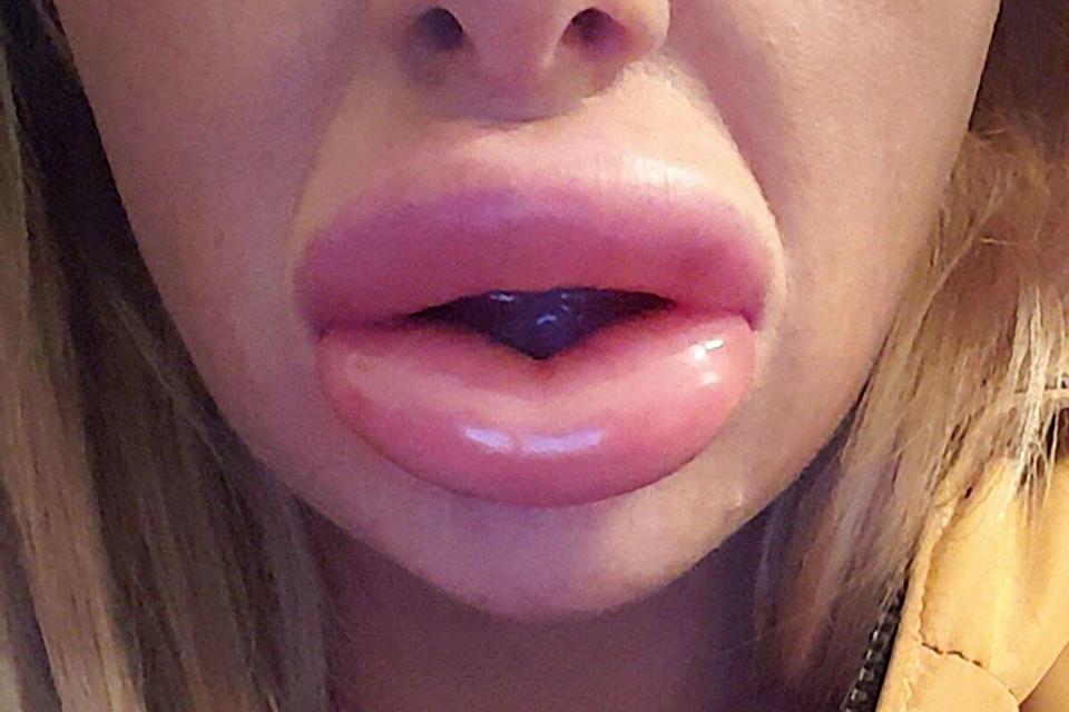  Leona Omalley, 24, from Greater Manchester, took advantage of a cheap deal on lip fillers she found online but she had a bad reaction which caused her lips to swell and become painful