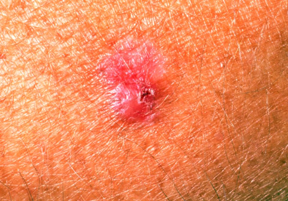 Basal cell carcinoma is one of the most common forms on non-melanoma skin cancer