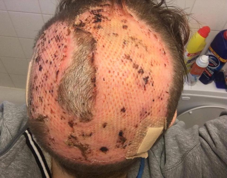 This was Kirsty's head a few weeks after doctors changed her bandages for the first time following her skin graft operation