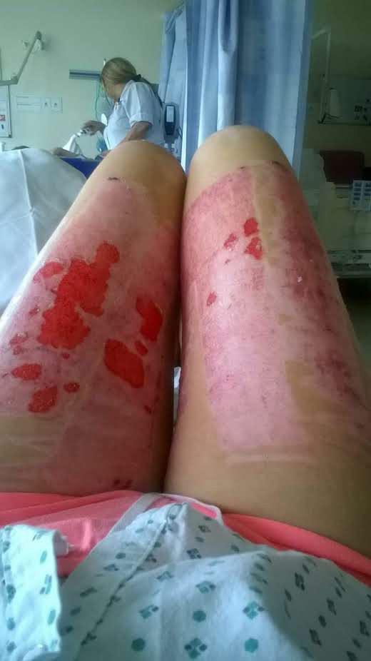  Photo shows skin grafts taken from Beata's legs