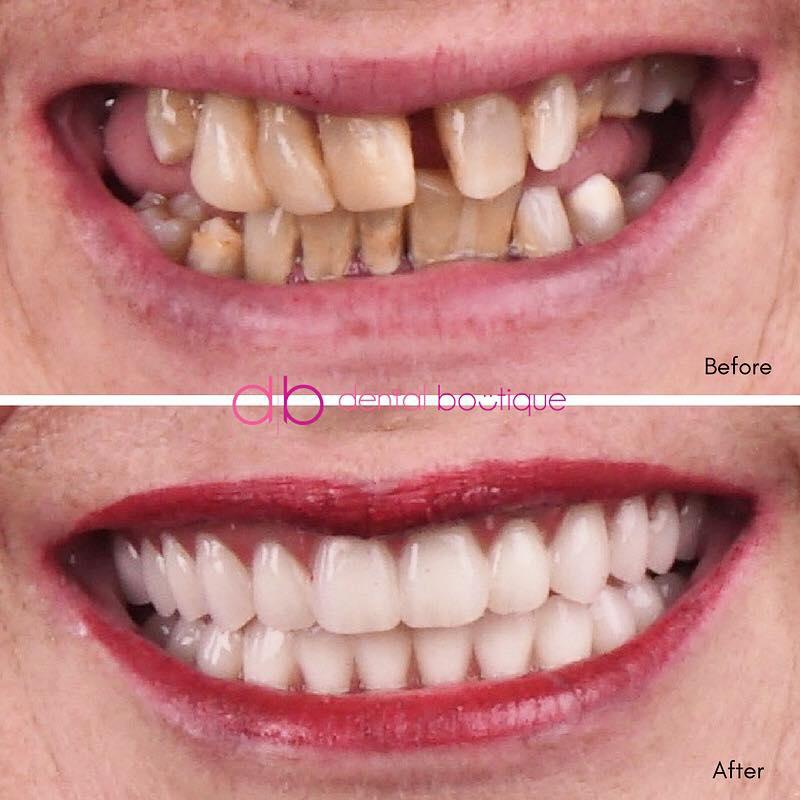 Terese underwent an All-On-Four dental procedure, suitable for individuals with tooth decay, gum disease or missing teeth