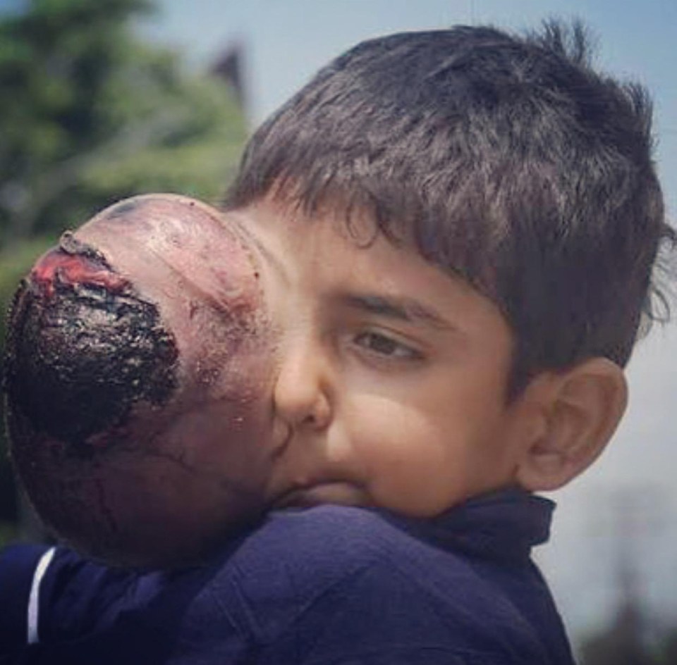 Ali Hassan suffered a major reaction to losing his eye when a giant tumour grew on his face