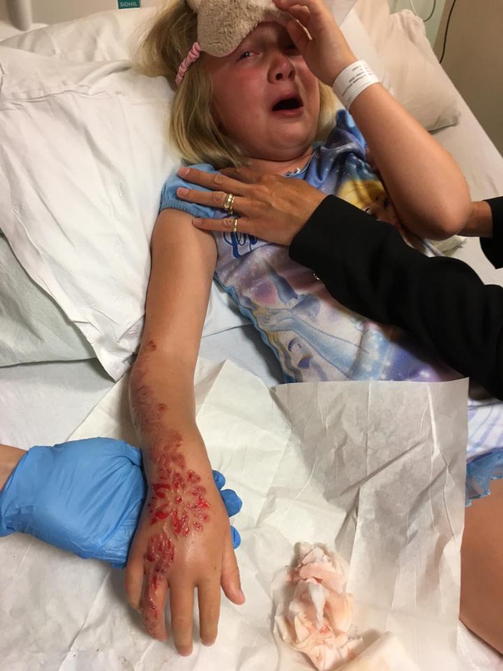 Madison Gulliver suffered a nasty chemical burn after having a black henna tattoo on holiday