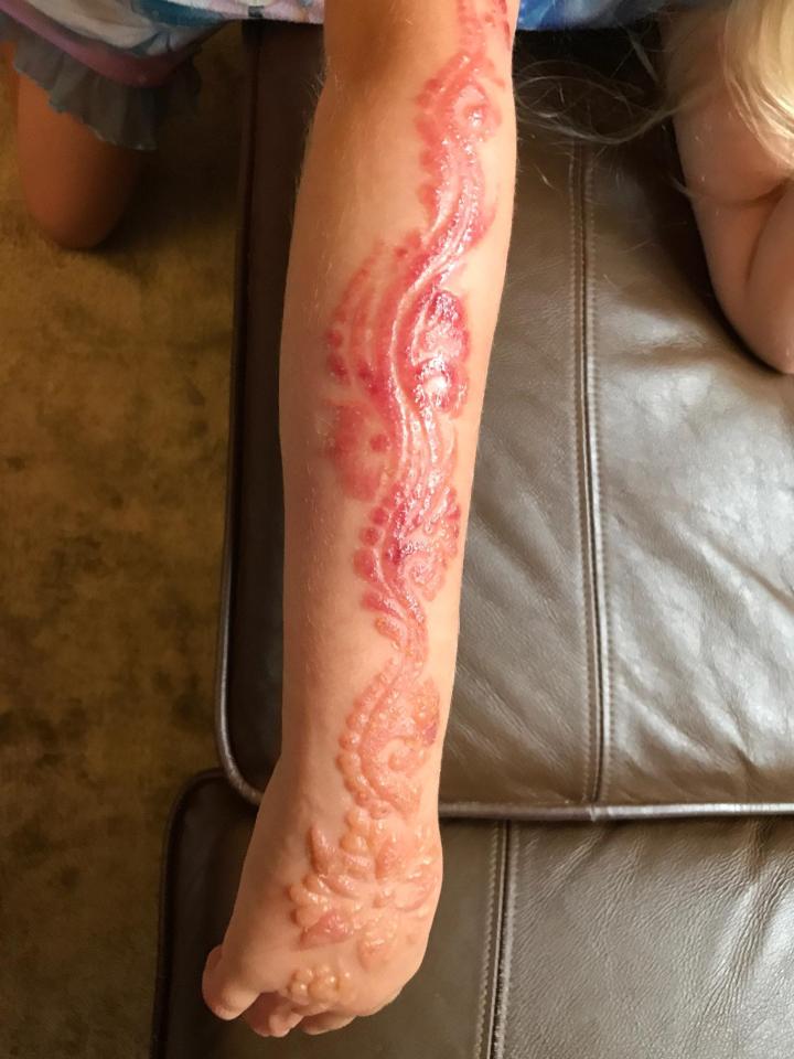 After washing the henna off Madison's skin when it began to itch, her parents noticed it became red and inflamed