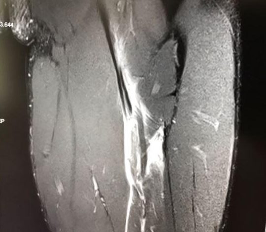  Usain Bolt released and then deleted this X-ray of his torn hamstring