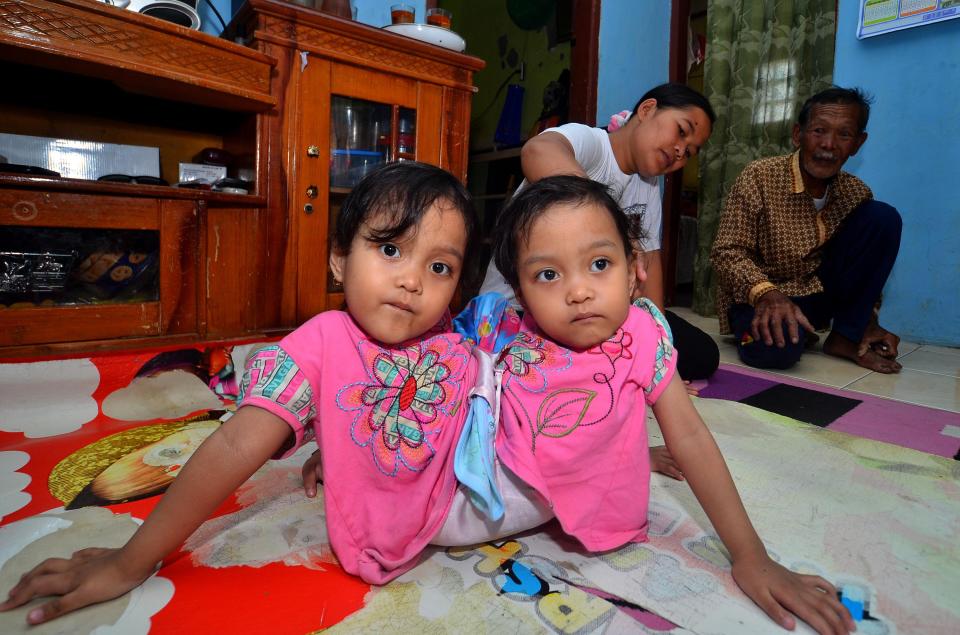  Conjoined twin sisters Dwi Ningsih and Anugrah from Indonesia were born joined at the waist