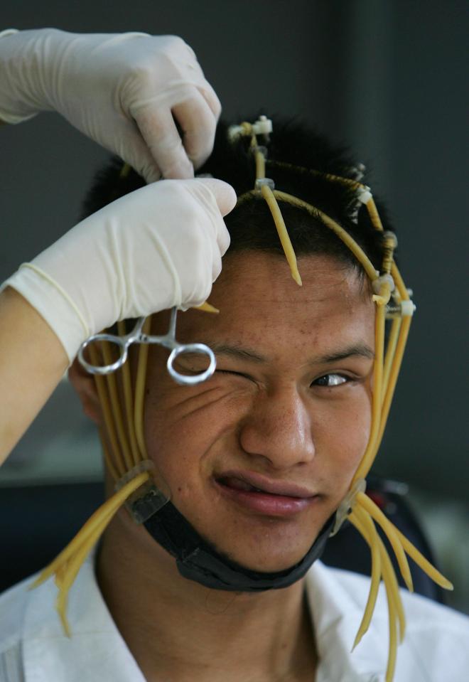  A patient grimaces as the electric probes are pulled from his head after an electroencephalogram check