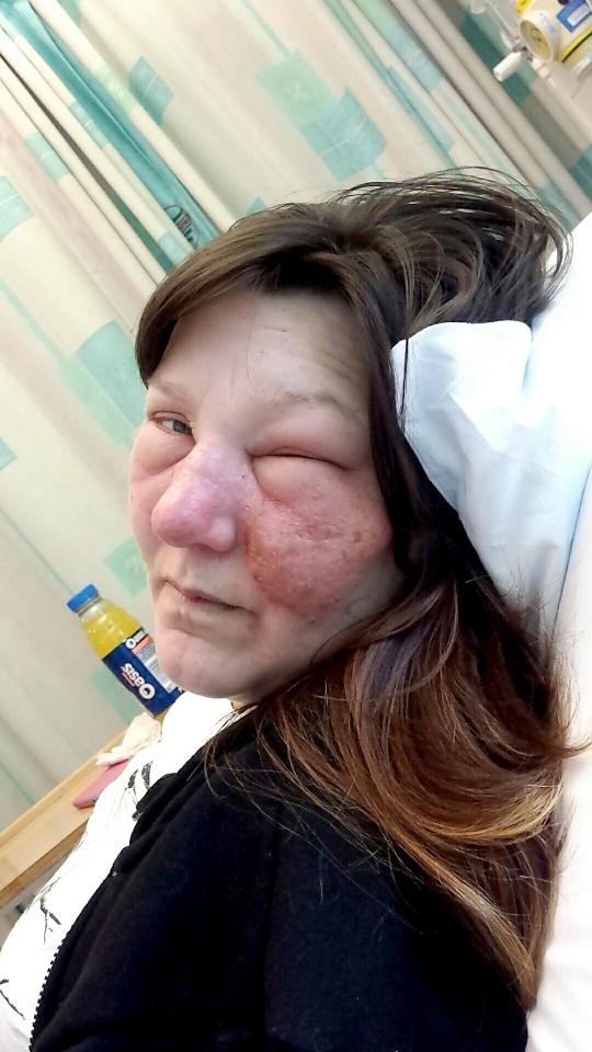 Doctors were concerned the infection could affect Anita's eyesight