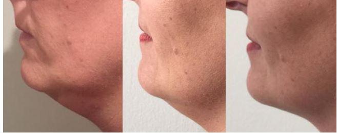  Belkyra is an injection that dissolves fat in the chin