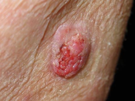 A squamous cell carcinoma can be a raised bump that sometimes bleed