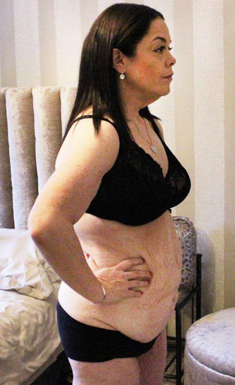  Lisa lost 12 stone but her excess skin still looked shocking