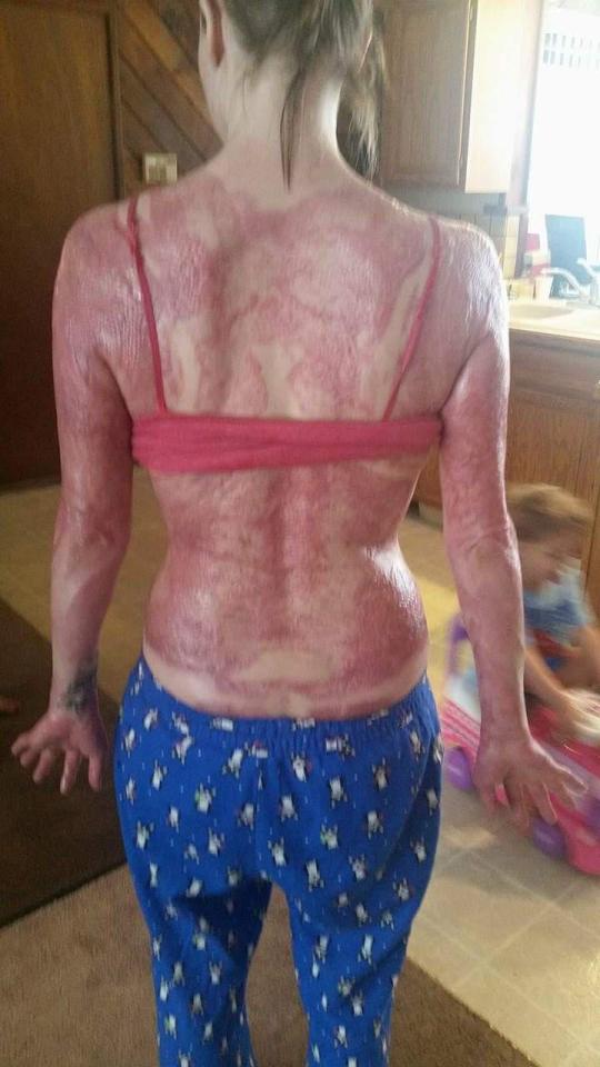  Angel suffered third degree burns over 43 per cent of her body. Pictured in January