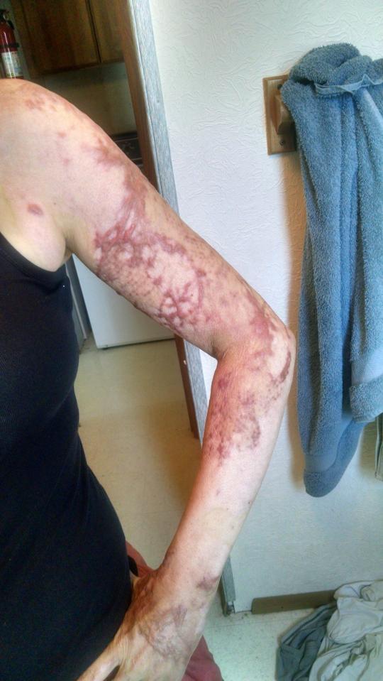  Angel suffered horrendous burns on her arms. Pictured in June as the scars heal