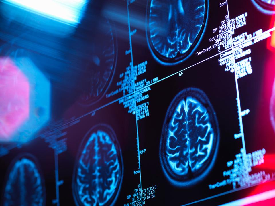 AI could be used to predict Alzheimer's