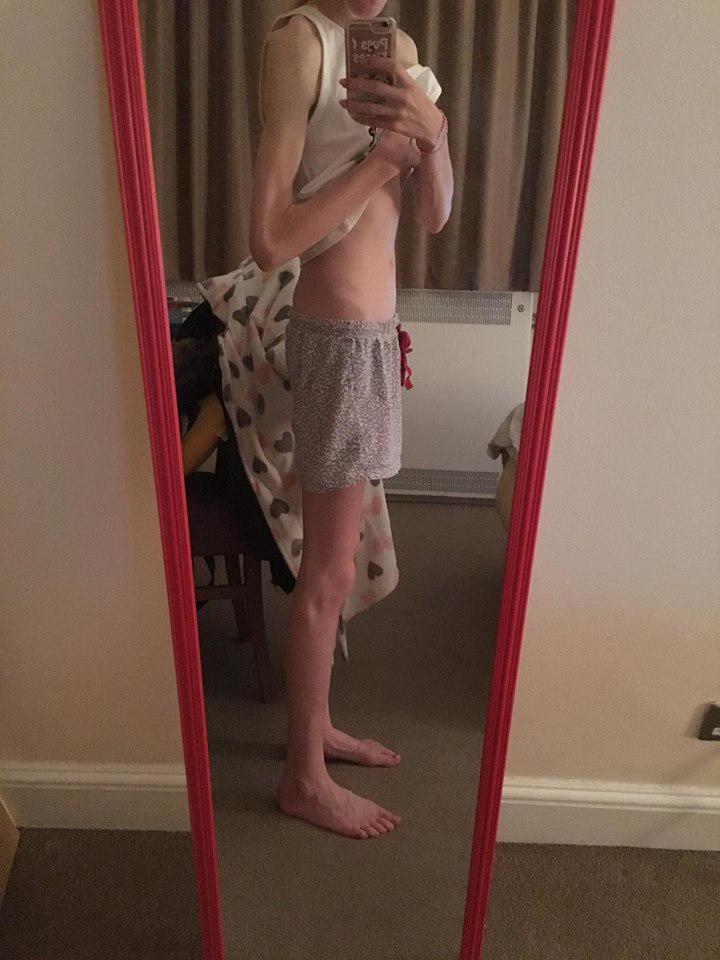  Becky, pictured at 5st 5lbs, was so skinny that her organs started to shrink