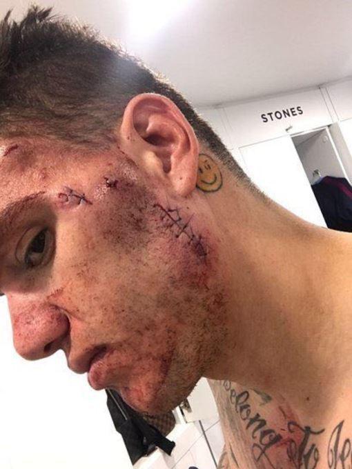 Ederson's face looked more than sore after the Sadio Mane collision