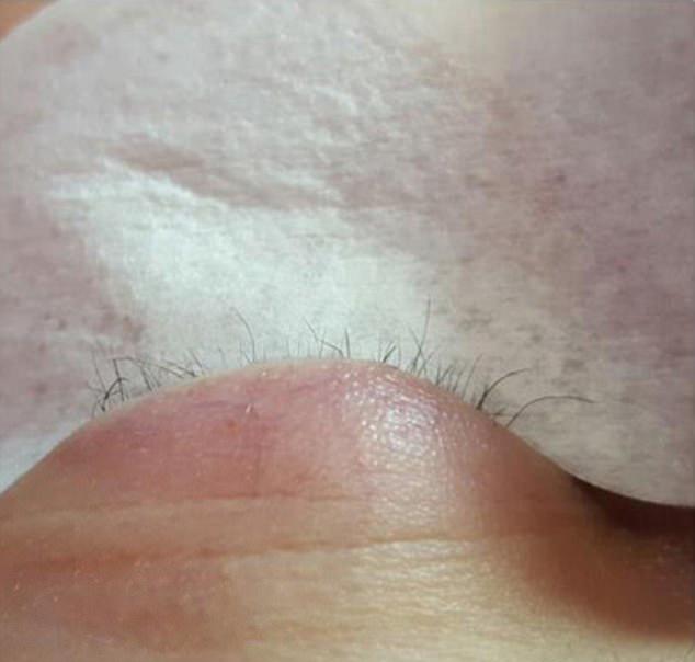  The damage was so severe that the woman was left with almost no natural lashes