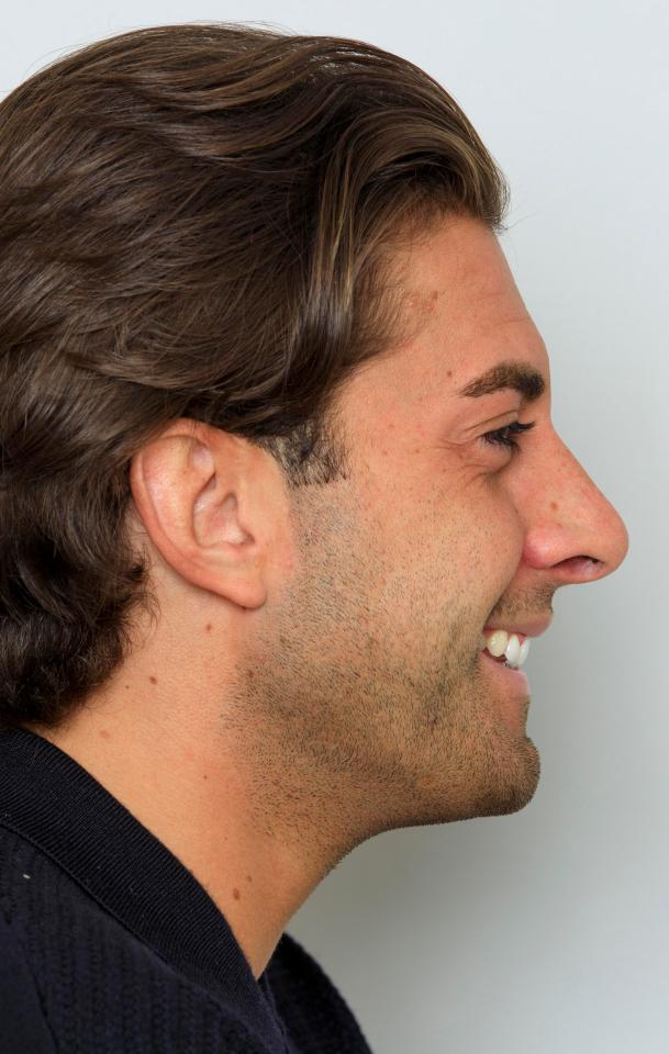  The Towie star admitted he panicked when the bandages were first removed after the swelling and 10 stiches inside his nostrils left him looking unrecognisable