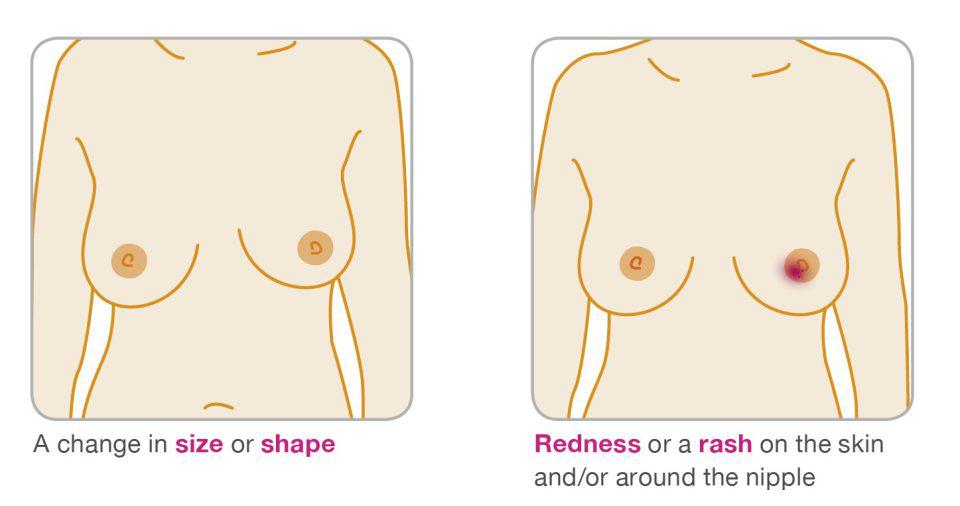 A change in size or shape is also a red flag sign for breast cancer