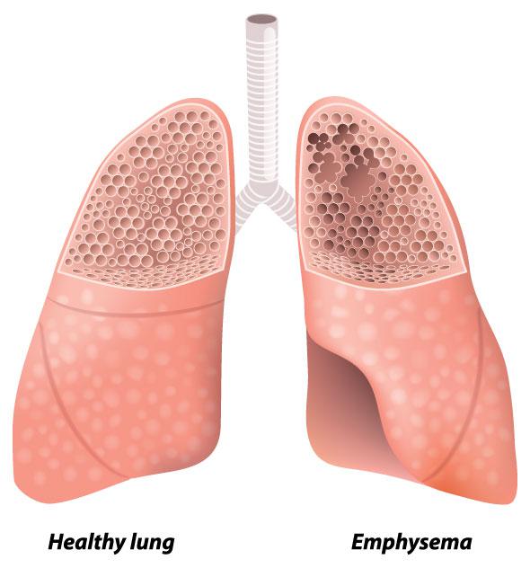  Emphysema damages the air sacs in the lungs causing breathlessness