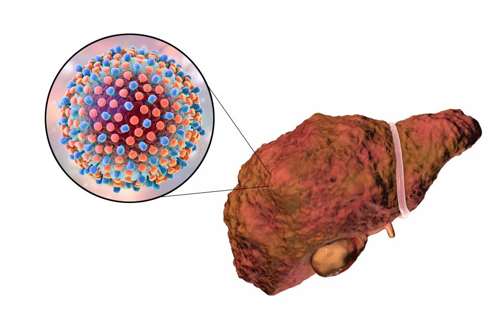  Liver cirrhosis is scar tissue on the liver