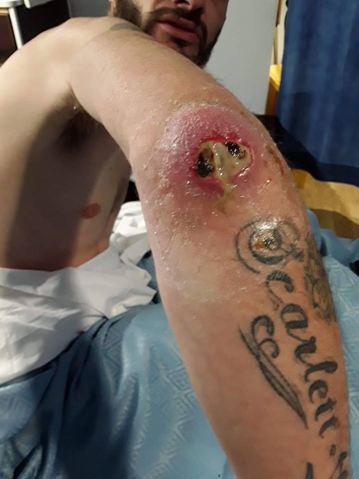  Rich, 33, was bitten on the elbow by a spider while he slept