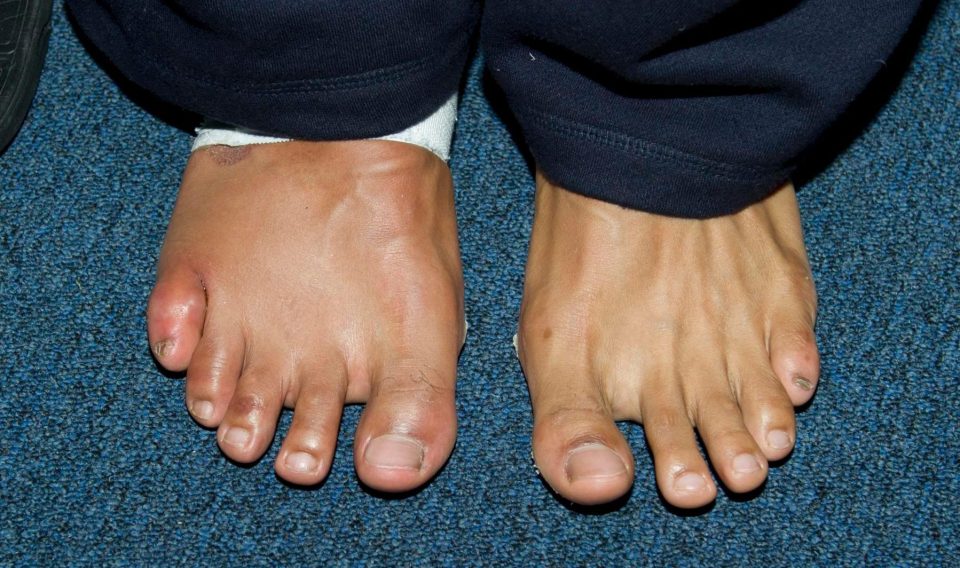  Haye broke his little toe in defeat to Wladimir Klitschko in 2011