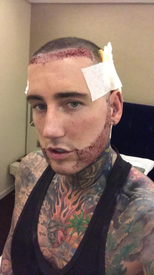 Jeremy McConnell headed to Turkey for a hair and beard trransplant