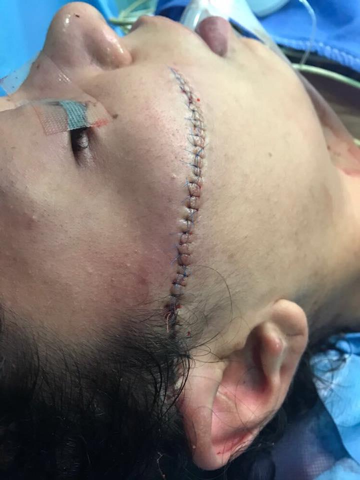 Somaya posted this image of the wound fully stitched up – which required 50 stitches