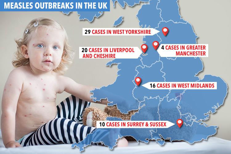  The number of measles cases confirmed across the UK so far