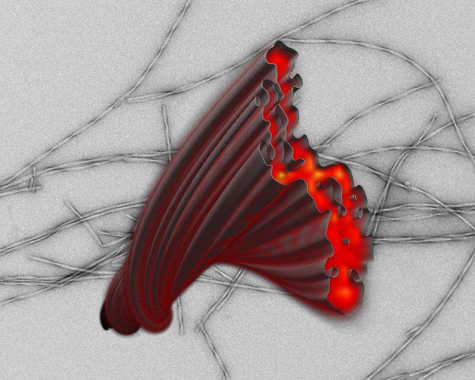  The faulty gene which causes the disease is passed on and inherited by sufferers' children