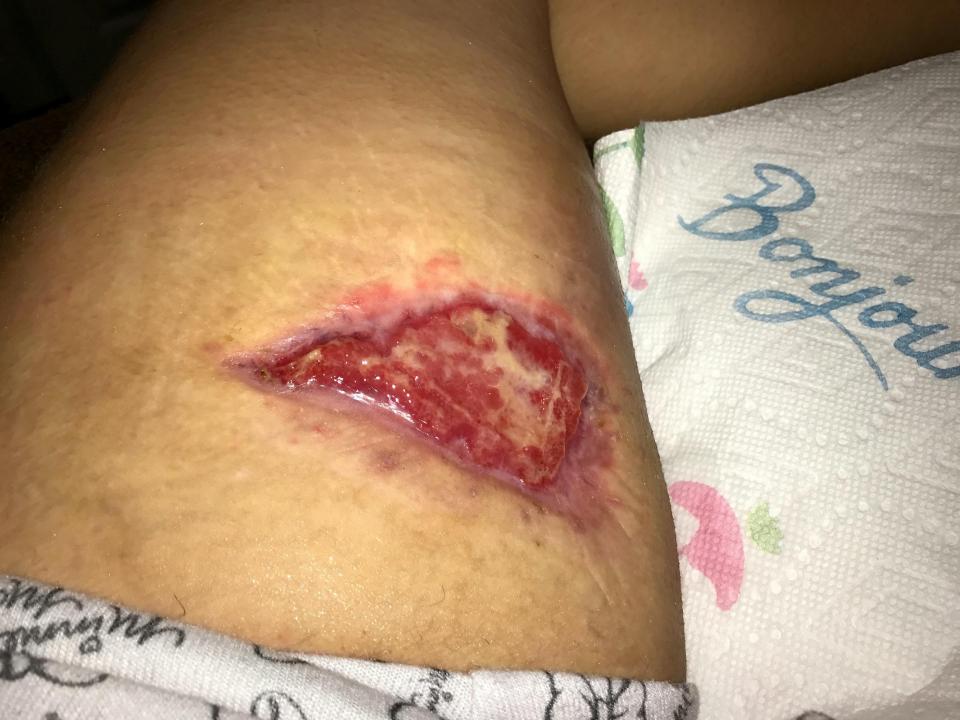  Sydney Shipley, 21, from the US, had an emergency operation to remove a chunk of her leg, measuring 8ins by 6ins, and was warned she was just hours away from losing her leg after heat rash turned into necrotising fasciitis