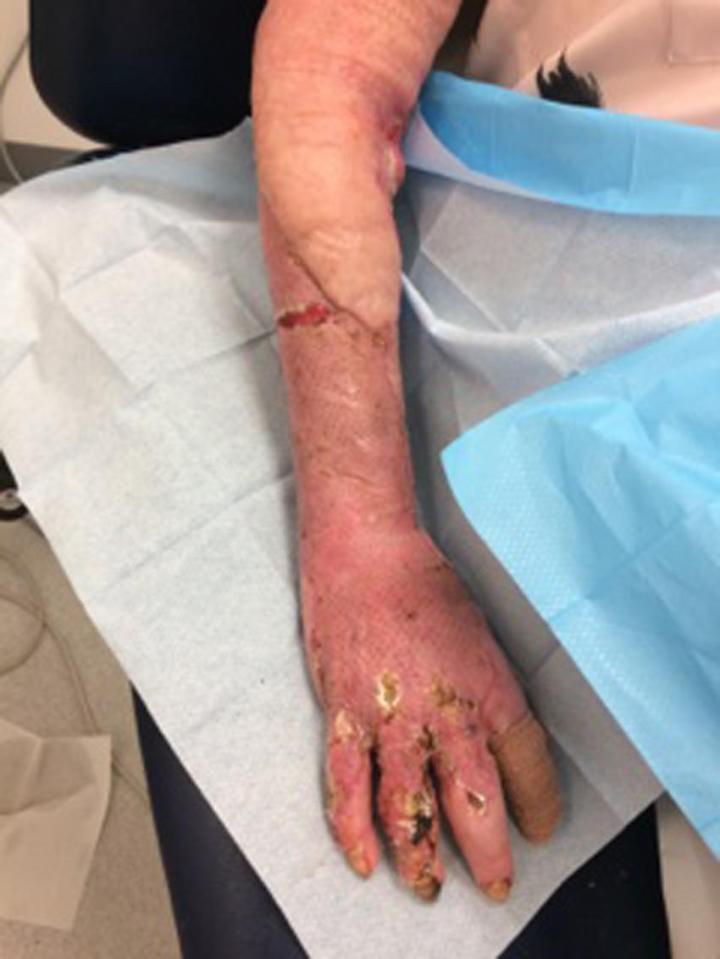 The infection caused the skin on Beverley's arm to die and she needed skin grafts to repair it