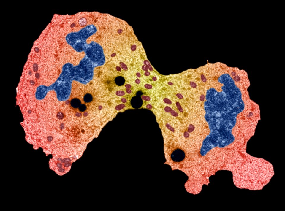  Your treatment will depend on the type of sarcoma you have and these can be grouped into soft tissue and bone sarcomas