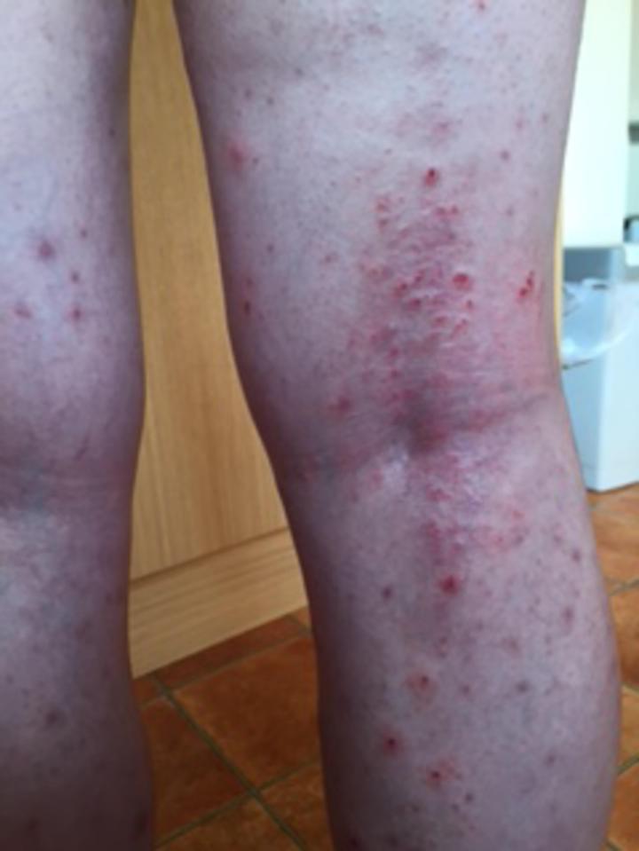 Megan's eczema caused her pain on a daily basis