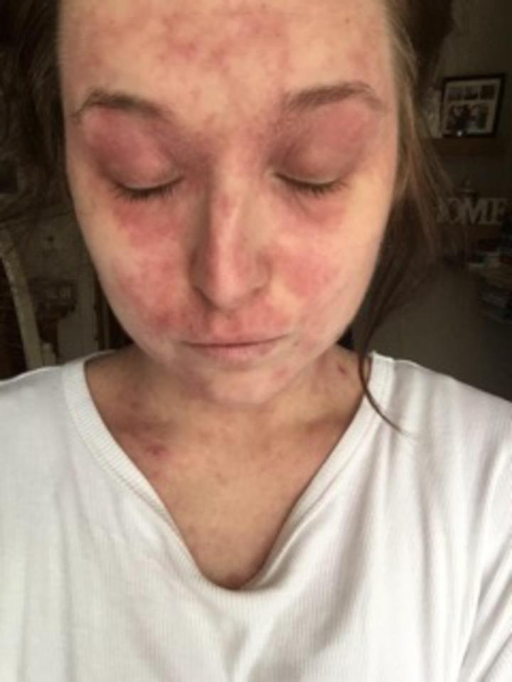 At its worst her eczema covered her entire face