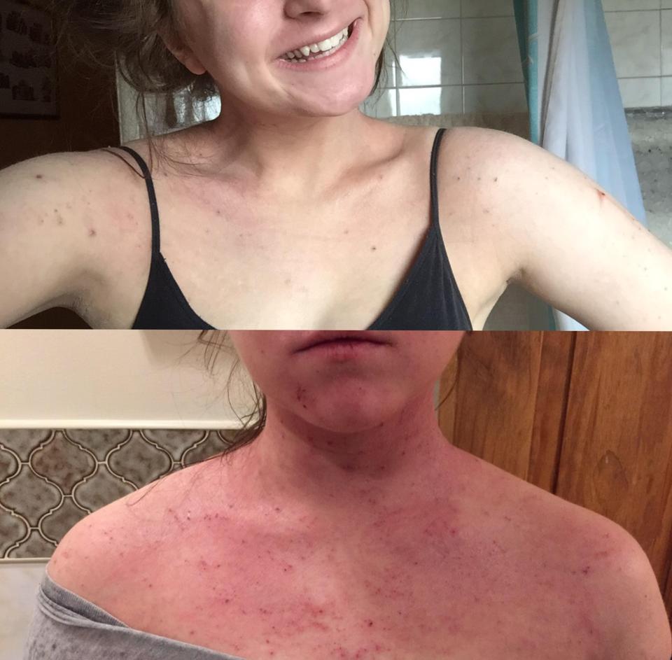 Since Megan has used MooGoo udder cream her eczema has cleared up