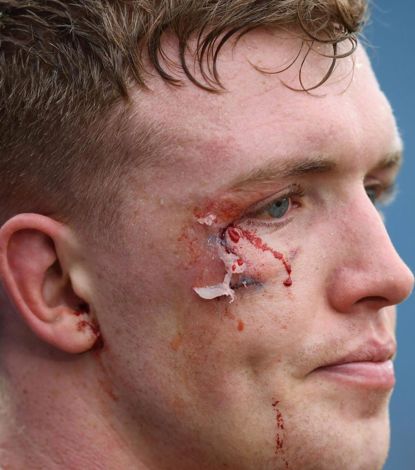  Dan Leavy sports a badly cut right eye