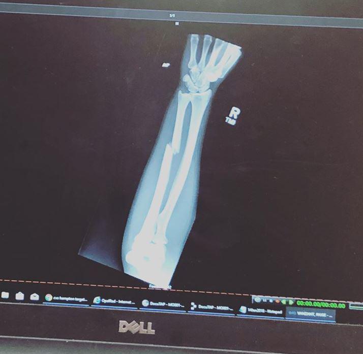  This is the X-Ray from the horror injury suffered by the brave Paige VanZant