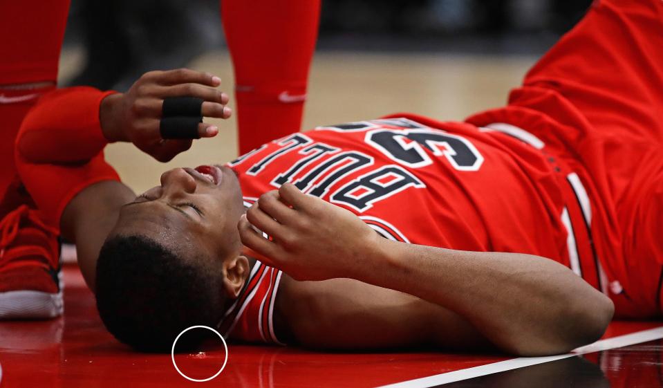 Kris Dunn loses part of his tooth after colliding with the floor