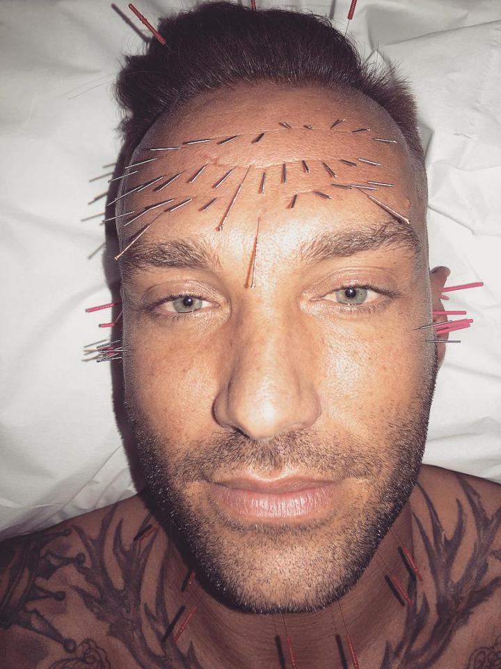  Calum Best told his fans he thought he looked 'stoned' during an acupuncture session